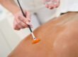 Provider brushing a chemical peel onto a woman's back to treat back acne and dark marks at PURE Medical Spa Chicago