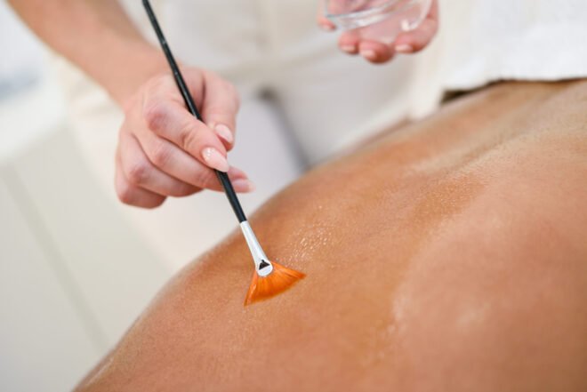 Provider brushing a chemical peel onto a woman's back to treat back acne and dark marks at PURE Medical Spa Chicago