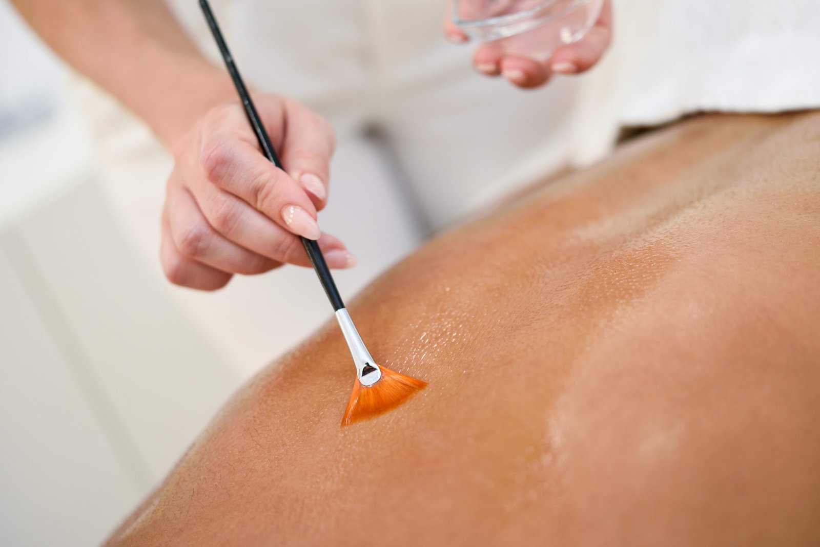 Chemical Peel for Back Acne in Chicago Provider brushing a chemical peel onto a woman's back to treat back acne and dark marks at PURE Medical Spa Chicago