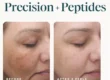 Before and after 3 VI Peel Precision + Peptides treatments showing faded dark spots and a more even skin tone, courtesy of VI Peel