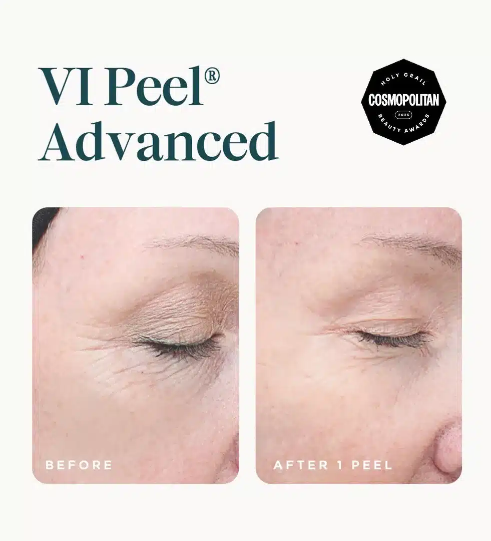 VI Peel Advanced before and after 1 peel showing softer fine lines around the eye VI Peel Advanced before and after 1 peel showing softer fine lines around the eye