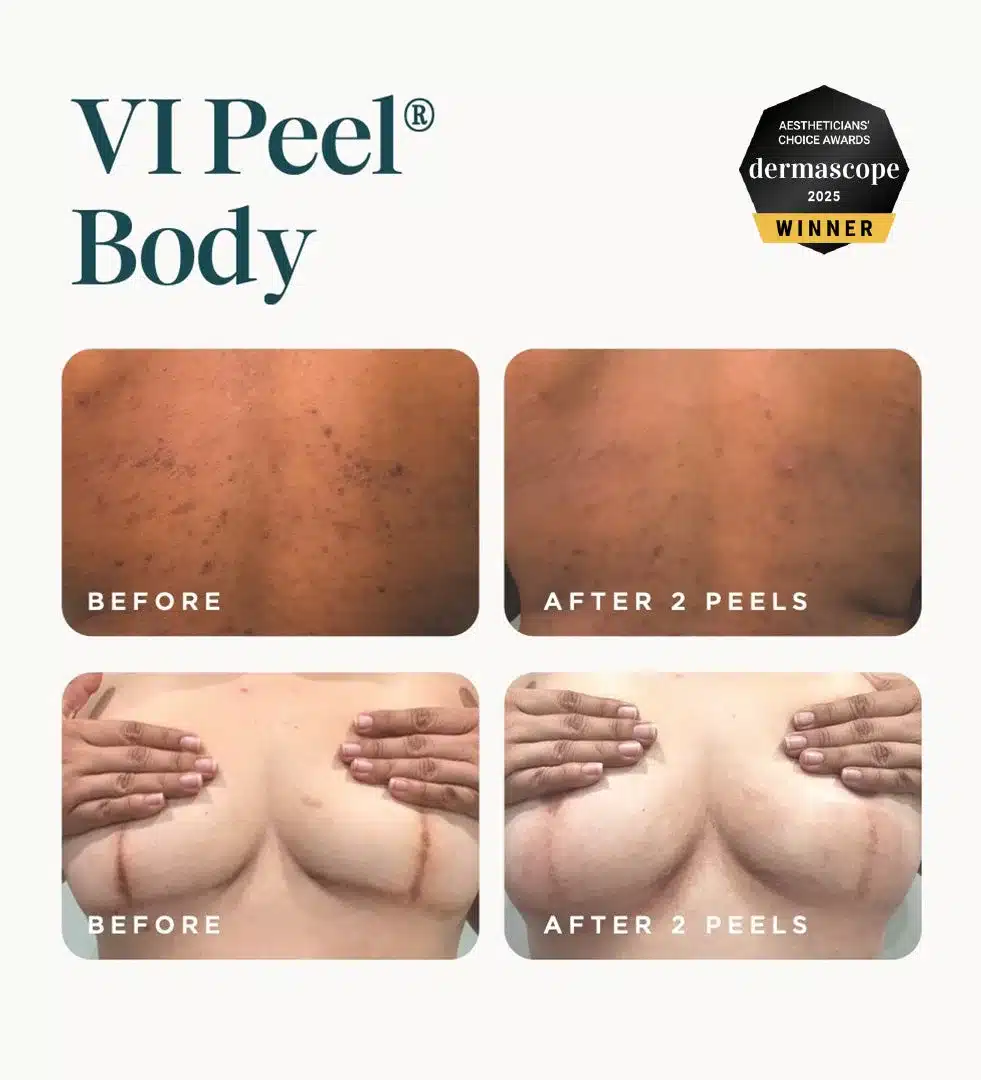 VI Peel Body before and after 2 peels on the back and chest VI Peel Body before and after 2 peels on the back and chest