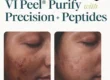 Before and after 3 VI Peel Purify with Precision + Peptides treatments showing fewer acne marks and smoother skin, courtesy of VI Peel