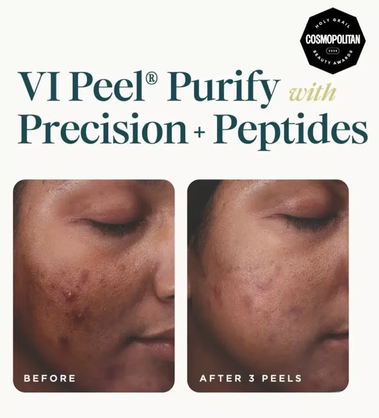 Before and after 3 VI Peel Purify with Precision + Peptides treatments showing fewer acne marks and smoother skin, courtesy of VI Peel