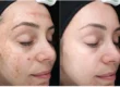 Before and after a VI Peel series showing lighter melasma patches on the cheek and a more even facial skin tone, courtesy of VI Peel