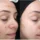 Before and after a VI Peel series showing lighter melasma patches on the cheek and a more even facial skin tone, courtesy of VI Peel