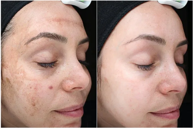 VI Peel for Melasma Before and After Before and after a VI Peel series showing lighter melasma patches on the cheek and a more even facial skin tone, courtesy of VI Peel