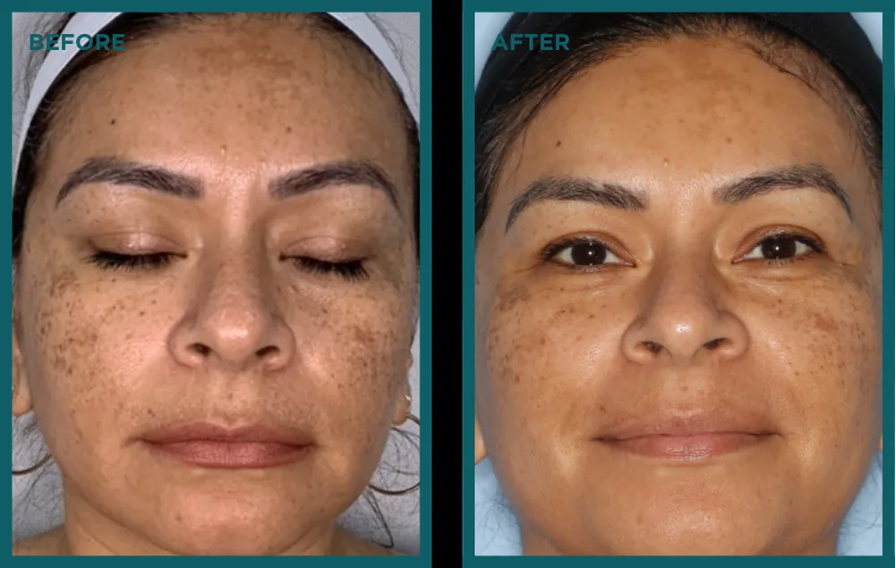 VI Peel plus laser before and after Before and after a VI Peel and laser combination treatment showing fewer dark spots and brighter skin