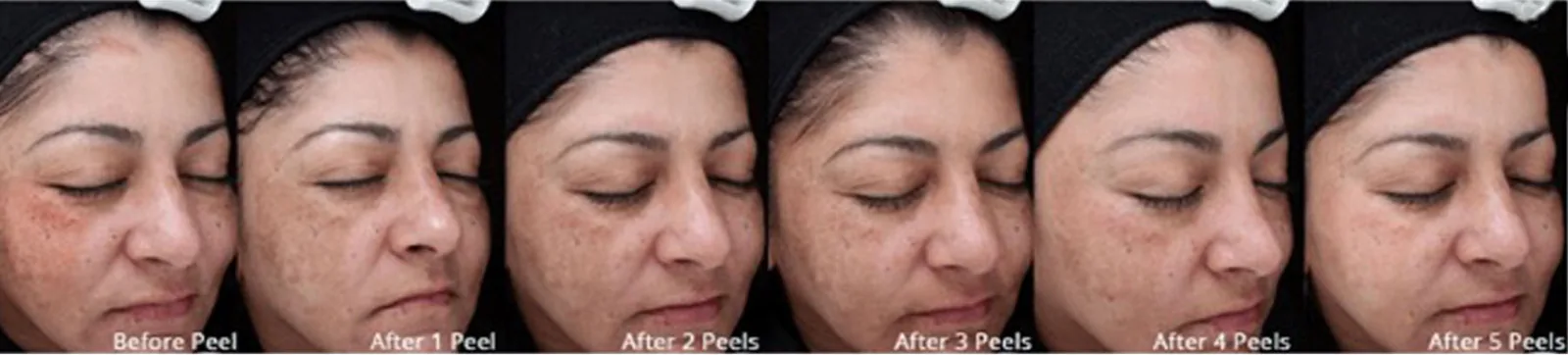 Melasma progression over a VI Peel series Melasma improving over a series of VI Peel Precision treatments, from before peel to after 5 peels