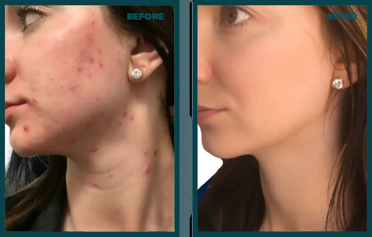 Before and after a microneedling and VI Peel series showing clearer skin with less acne and pigment Before and after a microneedling and VI Peel series showing clearer skin with less acne and pigment