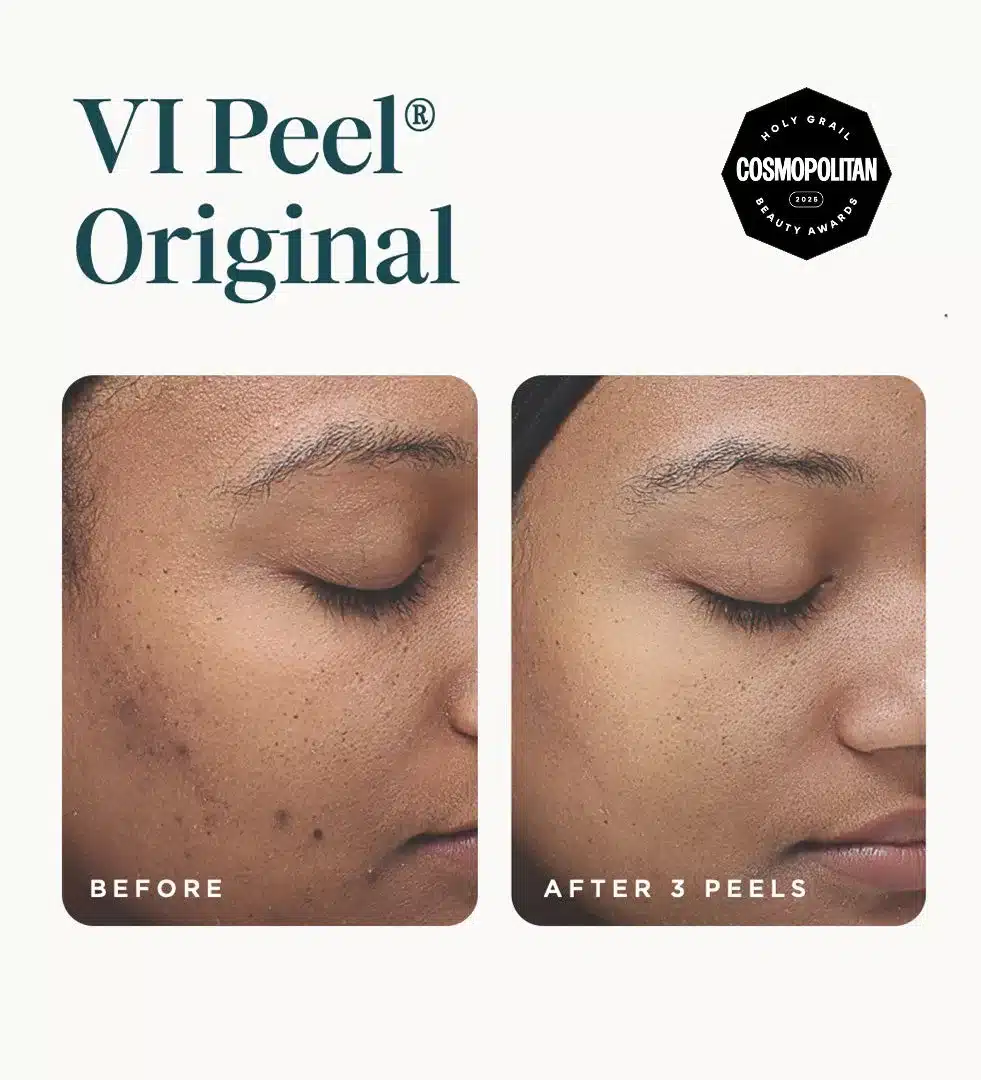 VI Peel Original before and after 3 peels showing smoother texture VI Peel Original before and after 3 peels showing smoother texture