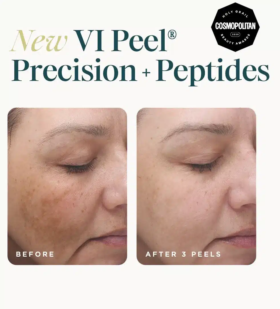 VI Peel Precision + Peptides before and after 3 peels showing faded pigmentation VI Peel Precision + Peptides before and after 3 peels showing faded pigmentation