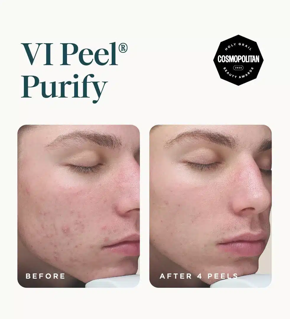 VI Peel Purify before and after 4 peels showing clearer acne-prone skin VI Peel Purify before and after 4 peels showing clearer acne-prone skin