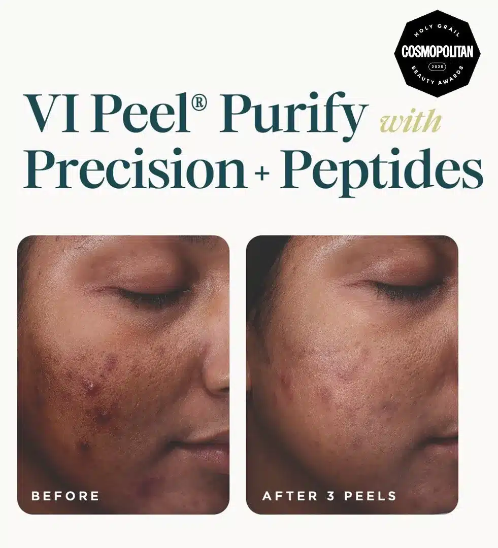 VI Peel Purify with Precision + Peptides before and after 3 peels showing clearer acne marks VI Peel Purify with Precision + Peptides before and after 3 peels showing clearer acne marks