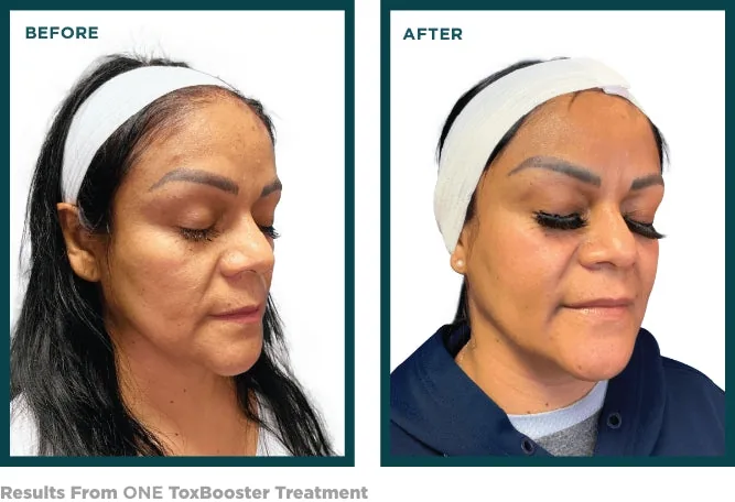Before and after one VI Peel ToxBooster treatment showing smoother skin and fewer dark spots