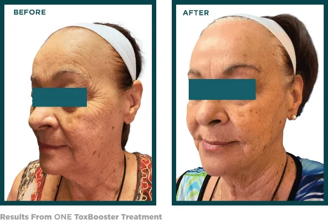 ToxBooster before and after: one treatment Before and after one VI Peel ToxBooster treatment showing softer wrinkles and brighter skin tone
