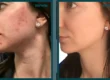 Before and after a VI Peel and microneedling series on separate days showing lighter acne marks and more even skin tone, courtesy of VI Peel