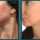 Before and after a VI Peel and microneedling series on separate days showing lighter acne marks and more even skin tone, courtesy of VI Peel